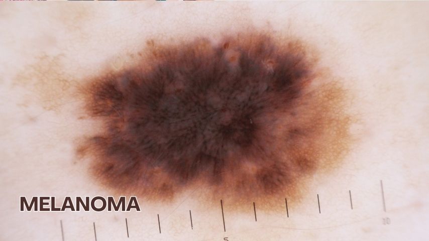 Melanoma