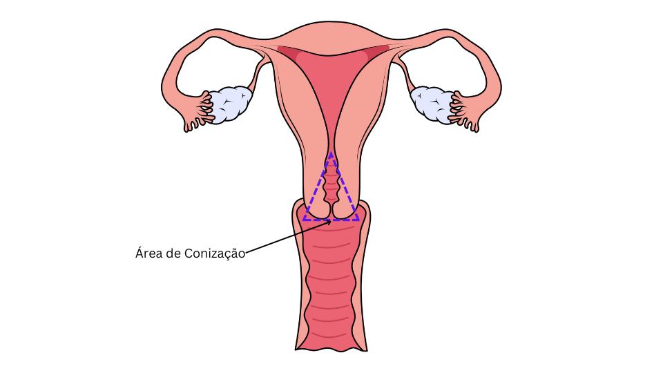 Cone biopsy