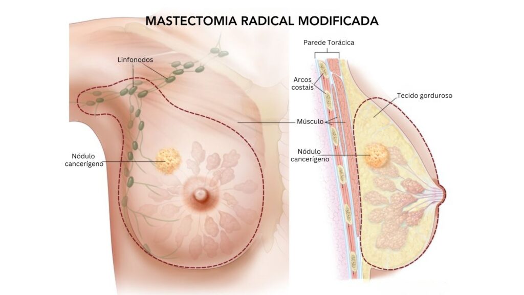 Mastectomia Radical Modificada