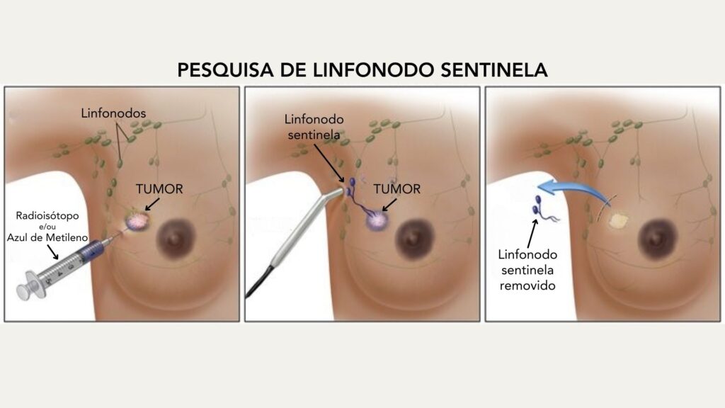 Biópsia de linfonodo sentinela no câncer de Mama