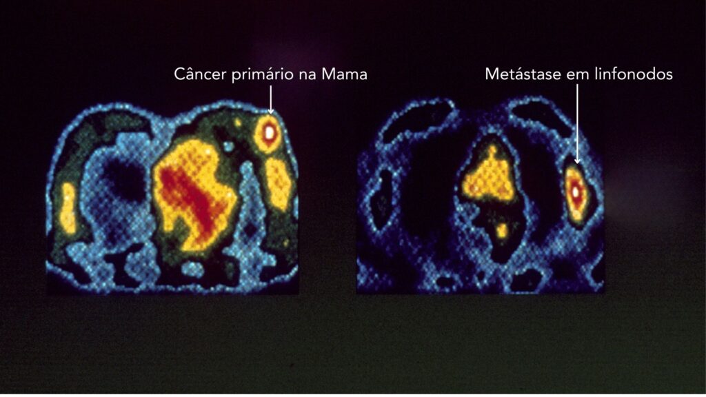 PET-Scan no câncer de mama