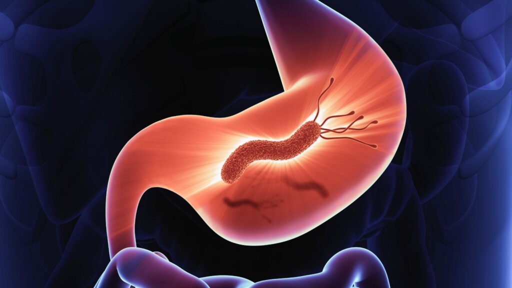 H pylori e endoscopia
