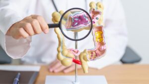 câncer de intestino