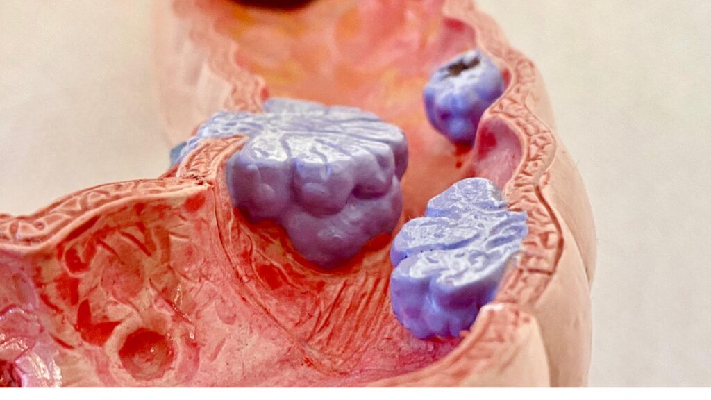 câncer de intestino